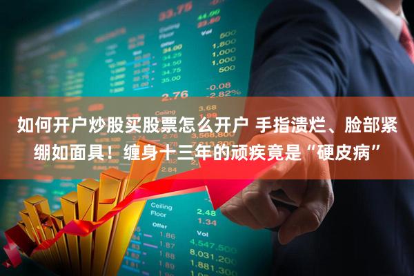 如何开户炒股买股票怎么开户 手指溃烂、脸部紧绷如面具！缠身十三年的顽疾竟是“硬皮病”